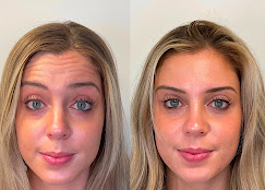 Botox before and after — forehead and brow area relaxed, blonde female client